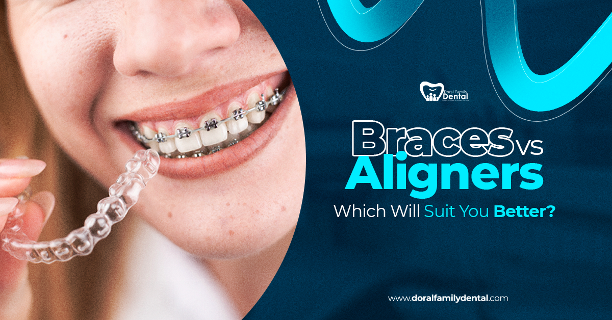 Braces vs Aligners – Which Will Suit You Better?