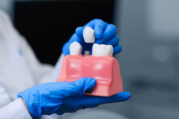 Tips For Implant Crown Care
