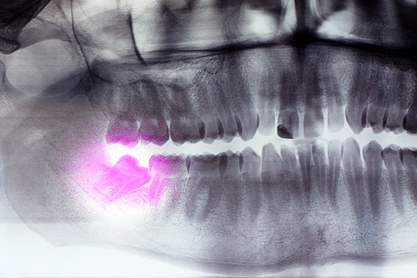 Recovery Time After Wisdom Tooth Extraction